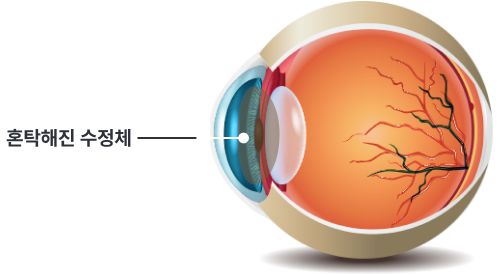 백내장이란?