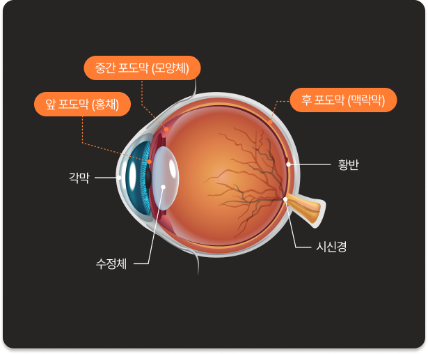 포도막염이란?