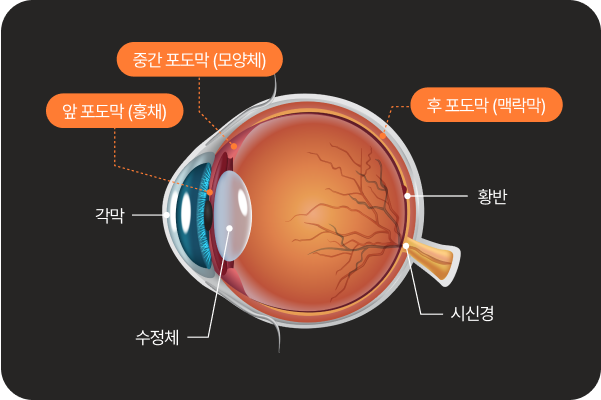 포도막염이란?