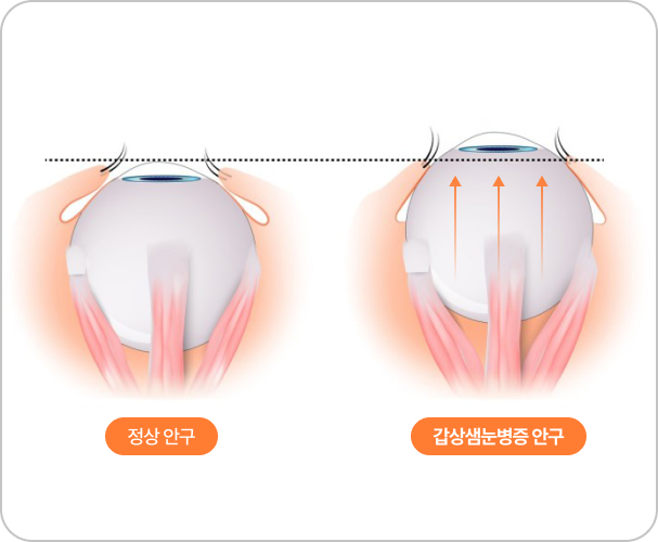 갑상샘눈병증?