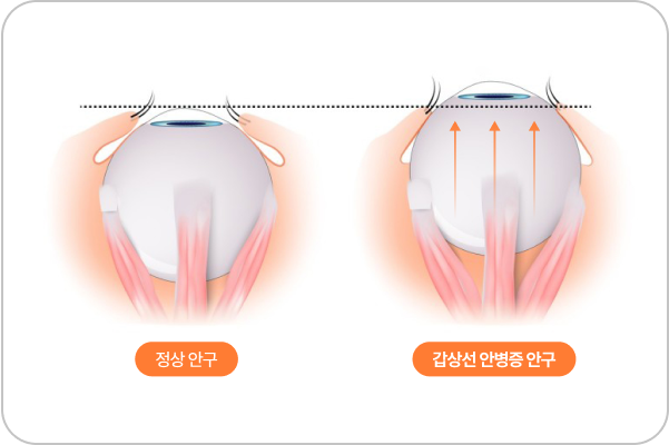 갑상샘눈병증?