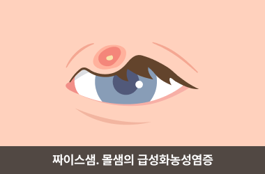 겉다래끼