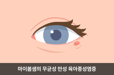 콩다래끼